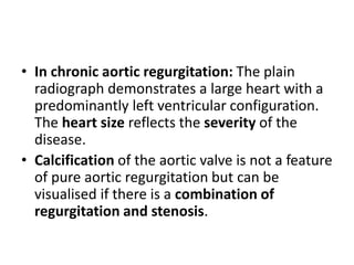 • In chronic aortic regurgitation: The plain
radiograph demonstrates a large heart with a
predominantly left ventricular configuration.
The heart size reflects the severity of the
disease.
• Calcification of the aortic valve is not a feature
of pure aortic regurgitation but can be
visualised if there is a combination of
regurgitation and stenosis.
 