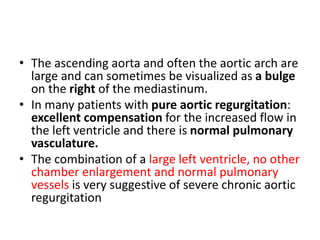 • The ascending aorta and often the aortic arch are
large and can sometimes be visualized as a bulge
on the right of the mediastinum.
• In many patients with pure aortic regurgitation:
excellent compensation for the increased flow in
the left ventricle and there is normal pulmonary
vasculature.
• The combination of a large left ventricle, no other
chamber enlargement and normal pulmonary
vessels is very suggestive of severe chronic aortic
regurgitation
 