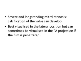 • Severe and longstanding mitral stenosis:
calcification of the valve can develop.
• Best visualised in the lateral position but can
sometimes be visualised in the PA projection if
the film is penetrated.
 