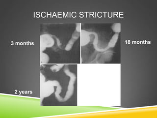 ISCHAEMIC STRICTURE
3 months 18 months
2 years
 