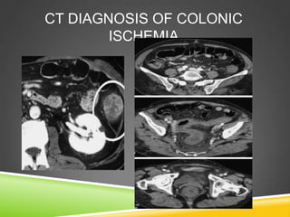 CT DIAGNOSIS OF COLONIC
ISCHEMIA
 