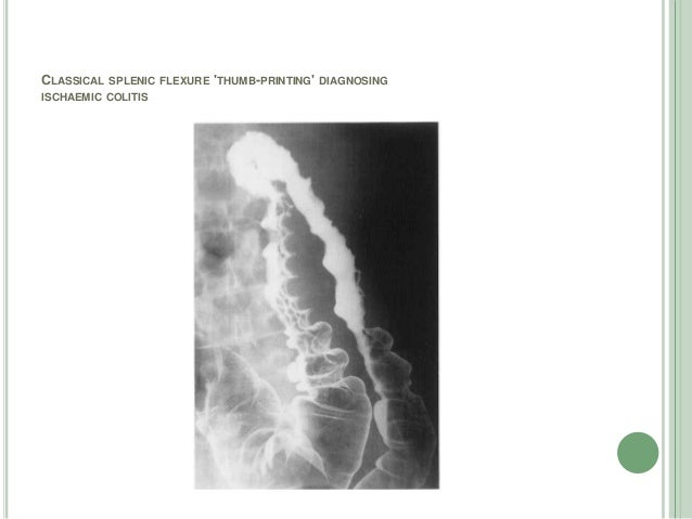 Thumbprinting In Abdominal Plain Film Of Ulcerative Colitis Eurorad