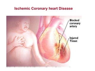 Ischemic   Coronary   heart Disease 