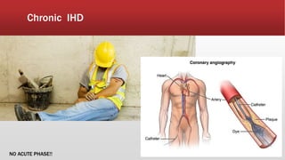 Chronic IHD
NO ACUTE PHASE!!
 