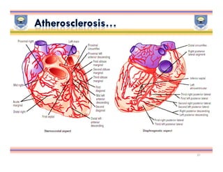 Ischemic heart disease | PDF