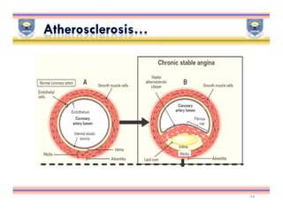 Ischemic heart disease | PDF