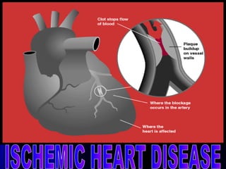 ISCHEMIC HEART DISEASE 