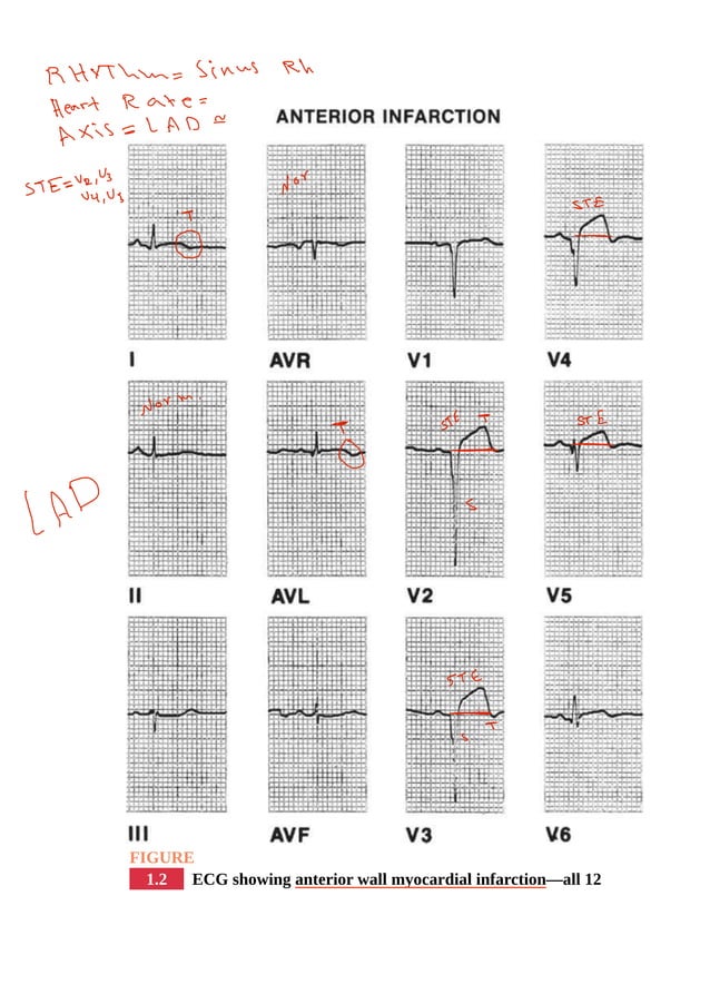 Ischemic Heart Disease - Myocardial Infarction.pdf