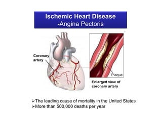 Ischemic Heart Disease
          -Angina Pectoris



Coronary
artery



                                        Plaque
                              Enlarged view of
                              coronary artery



The leading cause of mortality in the United States
More than 500,000 deaths per year
 