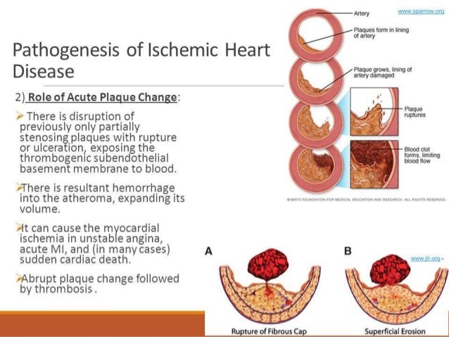 Ischemic Heart Disease