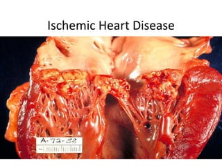 Ischemic Heart Disease
 