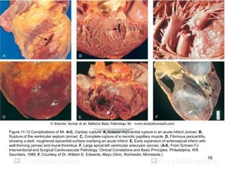 Figure 11-12 Complications of MI. A-C, Cardiac rupture. A, Anterior myocardial rupture in an acute infarct (arrow). B,
Rupture of the ventricular septum (arrow). C, Complete rupture of a necrotic papillary muscle. D, Fibrinous pericarditis,
showing a dark, roughened epicardial surface overlying an acute infarct. E, Early expansion of anteroapical infarct with
wall thinning (arrow) and mural thrombus. F, Large apical left ventricular aneurysm (arrow). (A-E, From Schoen FJ:
Interventional and Surgical Cardiovascular Pathology: Clinical Correlations and Basic Principles. Philadelphia, WB
Saunders, 1989. F, Courtesy of Dr. William D. Edwards, Mayo Clinic, Rochester, Minnesota.)

16

 