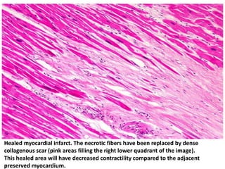 Healed myocardial infarct. The necrotic fibers have been replaced by dense
collagenous scar (pink areas filling the right lower quadrant of the image).
This healed area will have decreased contractility compared to the adjacent
preserved myocardium.
 