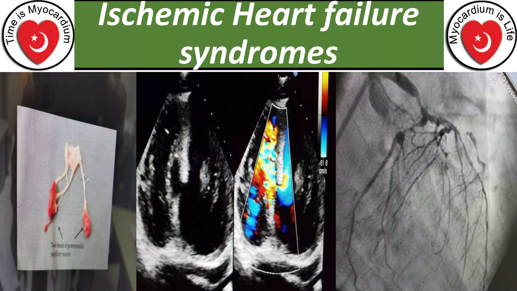 DOES ISCHEMIC HEART DISEASE CAUSE HEART FAILURE visual data 8