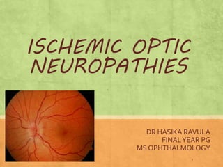 ISCHEMIC OPTIC
NEUROPATHIES
DR HASIKA RAVULA
FINALYEAR PG
MS OPHTHALMOLOGY
1
 