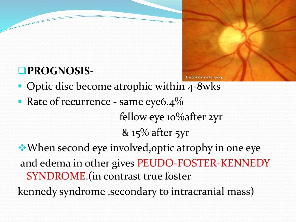 Ischemic optic neuropathy