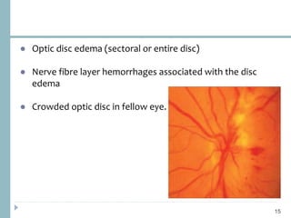● Optic disc edema (sectoral or entire disc)
● Nerve fibre layer hemorrhages associated with the disc
edema
● Crowded optic disc in fellow eye.
15
 