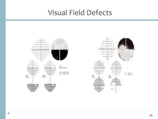 Visual Field Defects
16
 