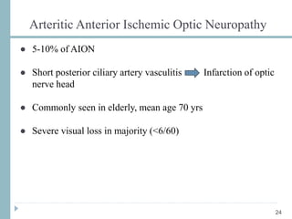 Arteritic Anterior Ischemic Optic Neuropathy
24
● 5-10% of AION
● Short posterior ciliary artery vasculitis Infarction of optic
nerve head
● Commonly seen in elderly, mean age 70 yrs
● Severe visual loss in majority (<6/60)
 