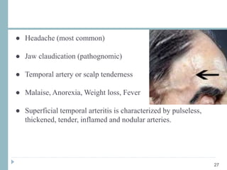 ● Headache (most common)
● Jaw claudication (pathognomic)
● Temporal artery or scalp tenderness
● Malaise, Anorexia, Weight loss, Fever
● Superficial temporal arteritis is characterized by pulseless,
thickened, tender, inflamed and nodular arteries.
27
 