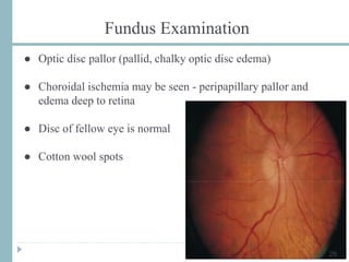 ● Optic disc pallor (pallid, chalky optic disc edema)
● Choroidal ischemia may be seen - peripapillary pallor and
edema deep to retina
● Disc of fellow eye is normal
● Cotton wool spots
29
Fundus Examination
 