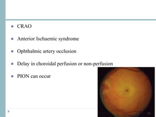 ● CRAO
● Anterior Ischaemic syndrome
● Ophthalmic artery occlusion
● Delay in choroidal perfusion or non-perfusion
● PION can occur
30
 
