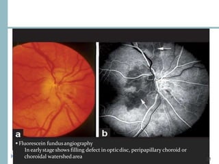  Fluorescein fundusangiography
In earlystageshows filling defect in opticdisc, peripapillary choroid or
choroidal watershedarea 31
 