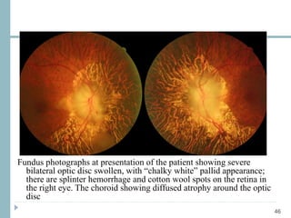 46
Fundus photographs at presentation of the patient showing severe
bilateral optic disc swollen, with “chalky white” pallid appearance;
there are splinter hemorrhage and cotton wool spots on the retina in
the right eye. The choroid showing diffused atrophy around the optic
disc
 