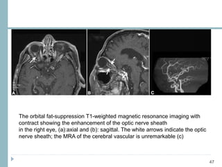 47
The orbital fat-suppression T1-weighted magnetic resonance imaging with
contract showing the enhancement of the optic nerve sheath
in the right eye, (a):axial and (b): sagittal. The white arrows indicate the optic
nerve sheath; the MRA of the cerebral vascular is unremarkable (c)
 