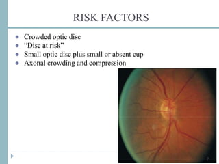 RISK FACTORS
● Crowded optic disc
● “Disc at risk”
● Small optic disc plus small or absent cup
● Axonal crowding and compression
7
 