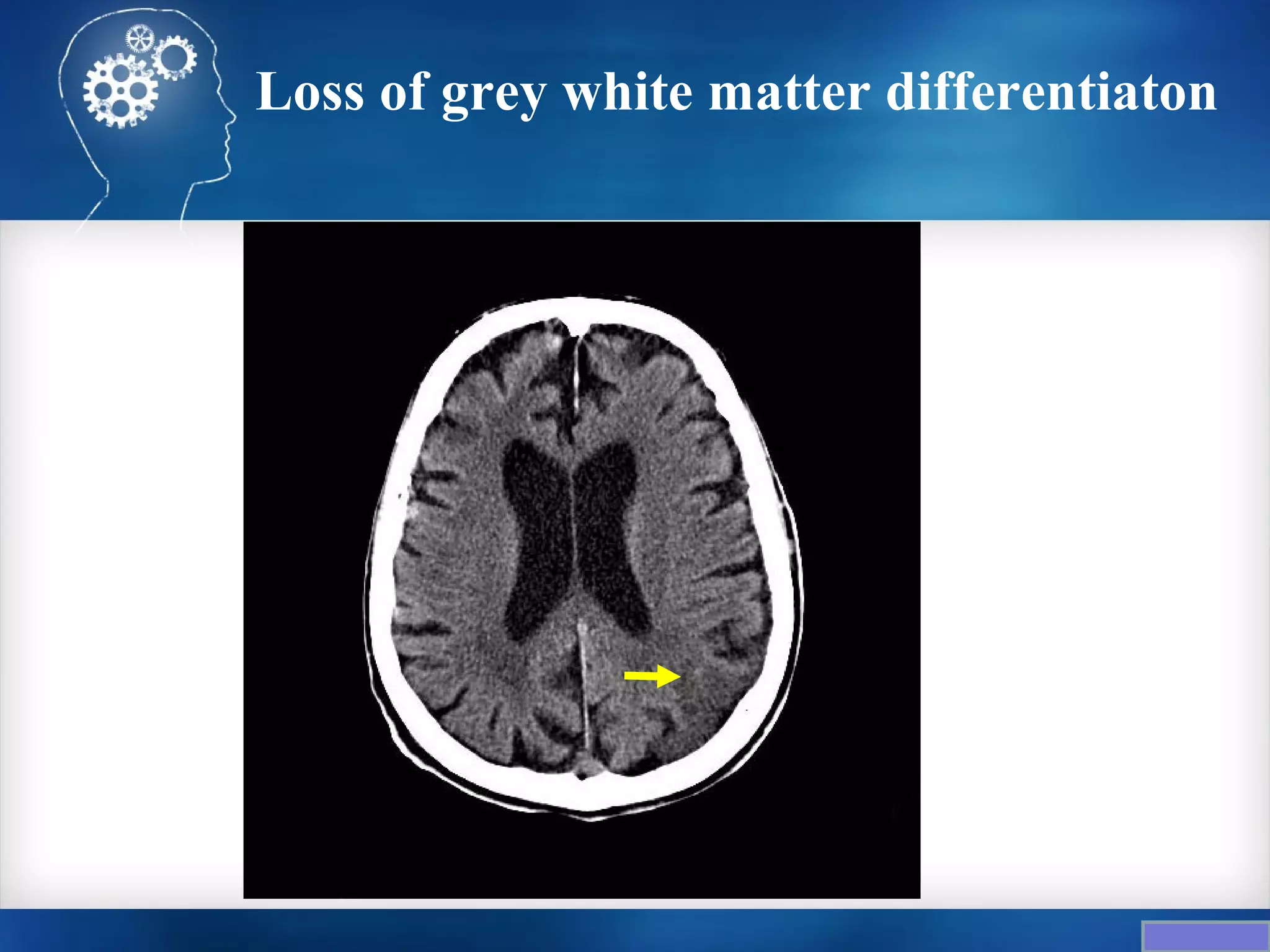Loss of grey white matter differentiaton
 