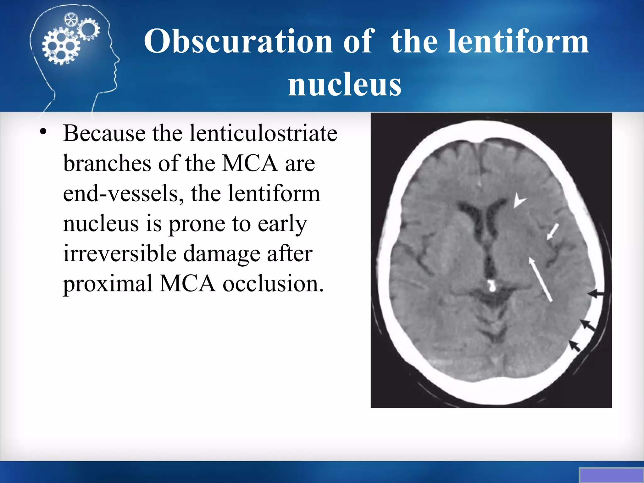 Obscuration of the lentiform
                  nucleus
• Because the lenticulostriate
  branches of the MCA are
  end-vessels, the lentiform
  nucleus is prone to early
  irreversible damage after
  proximal MCA occlusion.
 
