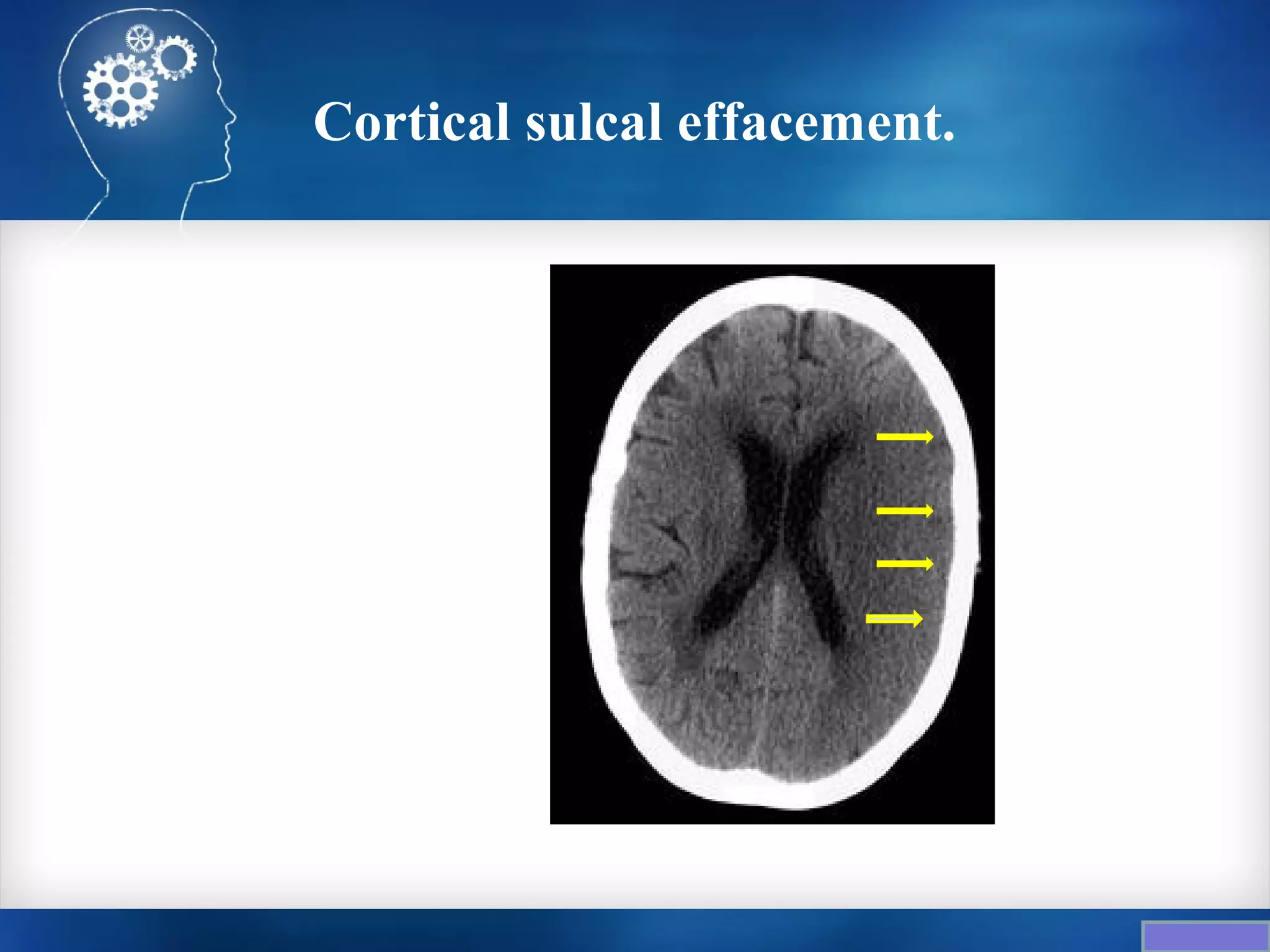 Cortical sulcal effacement.
 