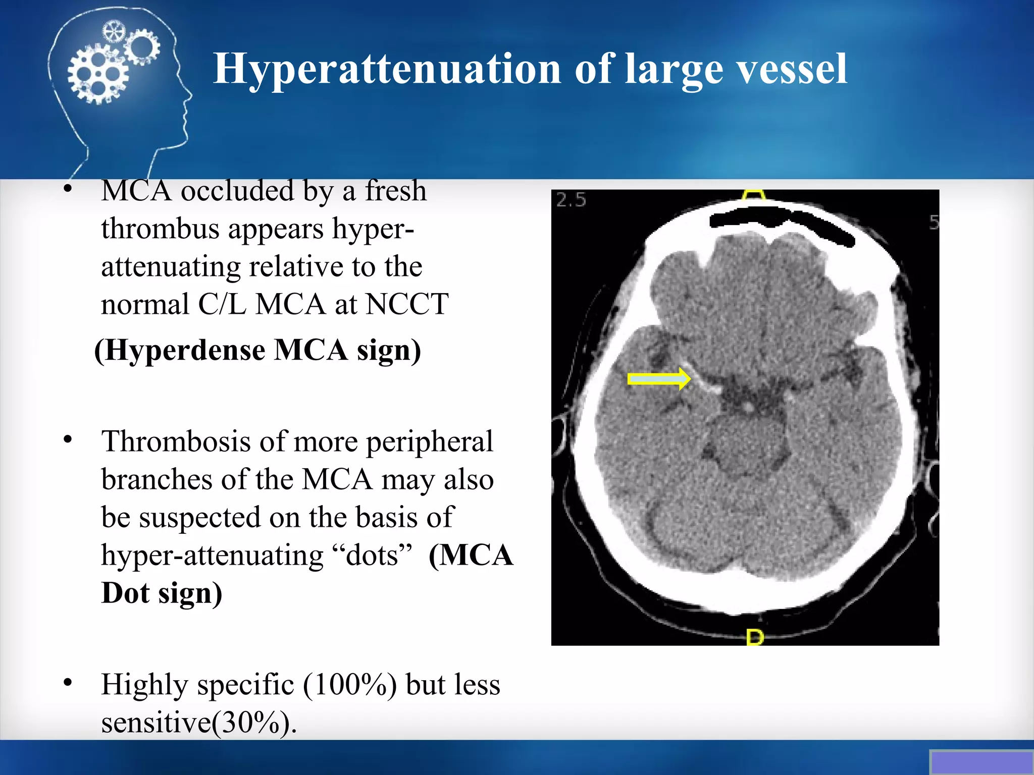 Hyperattenuation of large vessel

• MCA occluded by a fresh
   thrombus appears hyper-
   attenuating relative to the
   normal C/L MCA at NCCT
  (Hyperdense MCA sign)

• Thrombosis of more peripheral
  branches of the MCA may also
  be suspected on the basis of
  hyper-attenuating “dots” (MCA
  Dot sign)

• Highly specific (100%) but less
  sensitive(30%).
 