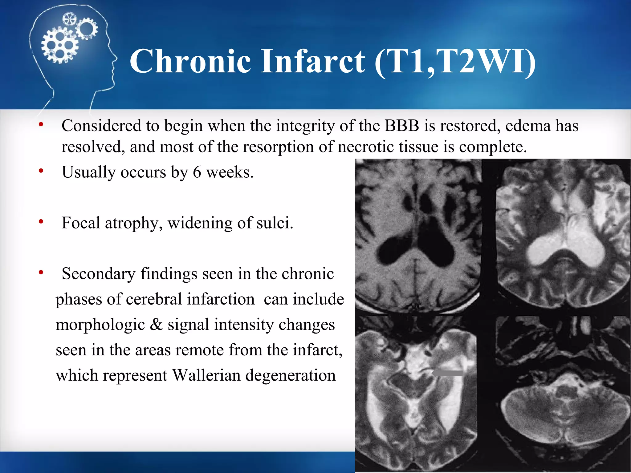 Chronic Infarct (T1,T2WI)
•   Considered to begin when the integrity of the BBB is restored, edema has
    resolved, and most of the resorption of necrotic tissue is complete.
•   Usually occurs by 6 weeks.

•   Focal atrophy, widening of sulci.

•    Secondary findings seen in the chronic
    phases of cerebral infarction can include
    morphologic & signal intensity changes
    seen in the areas remote from the infarct,
    which represent Wallerian degeneration
 