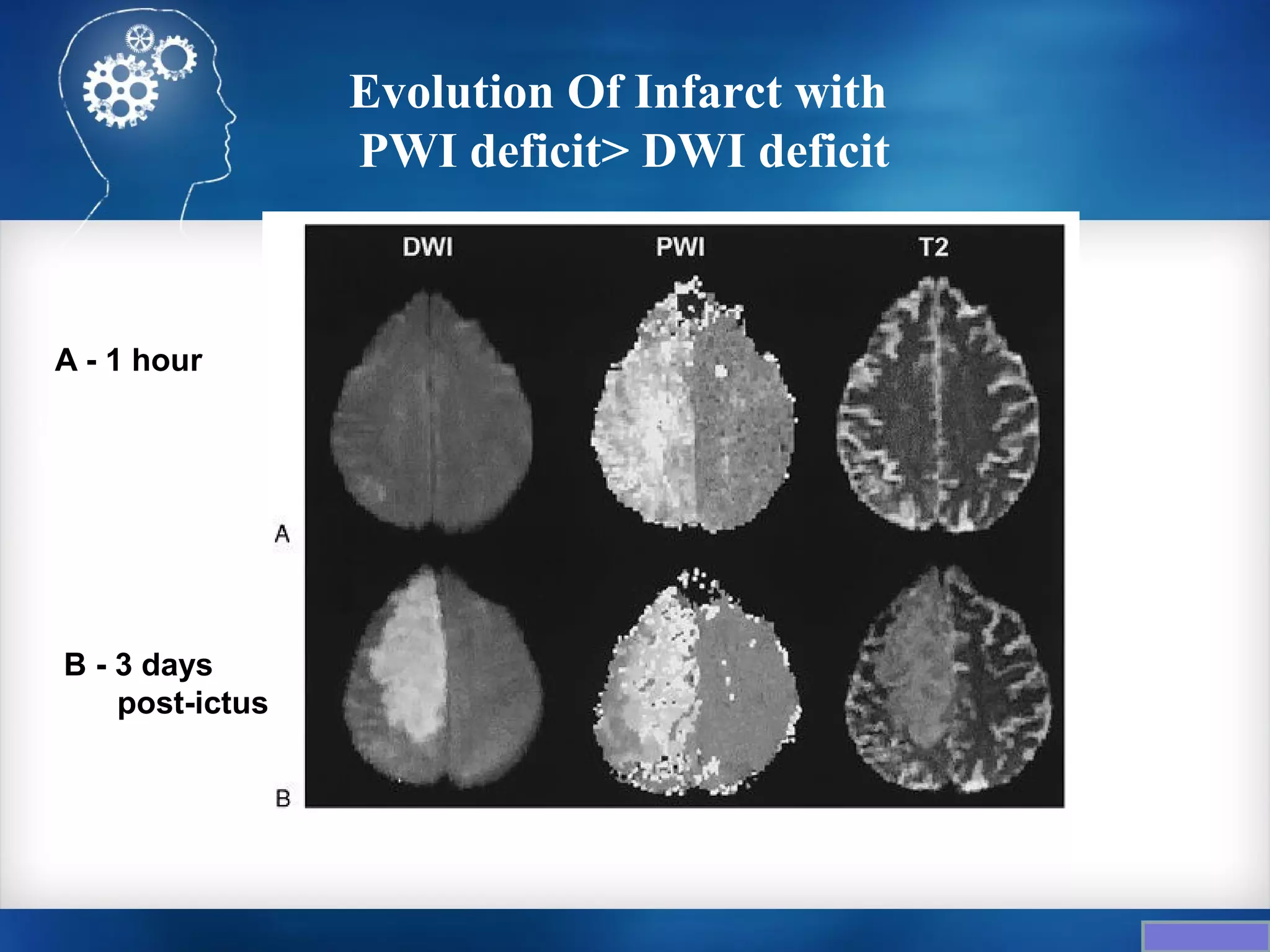 Evolution Of Infarct with
                 PWI deficit> DWI deficit



A - 1 hour




B - 3 days
    post-ictus
 