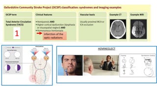 infarction of the
optic radiations
HEMINEGLECT
1
 