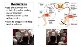 Hyperreflexia
• loss of net inhibitory
activity from descending
motor results in
disinhibition of spinal
reflex circuits.
• leads to exaggerated deep
tendon reflexes
 