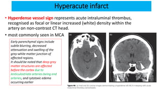 Hyperacute infarct
• Hyperdense vessel sign represents acute intraluminal thrombus,
recognised as focal or linear increased (white) density within the
artery on non-contrast CT head.
• most commonly seen in MCA
Early parenchymal signs include
subtle blurring, decreased
attenuation and swelling of the
grey-white matter junction of
affected regions.
It should be noted that deep grey
matter structures are affected
before the cortex due to
lenticulostriate arteries being end
arteries, and cytotoxic edema
occurring earlier..
 