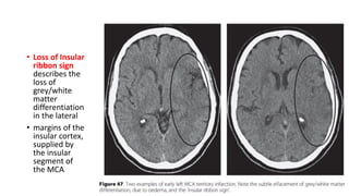 • Loss of Insular
ribbon sign
describes the
loss of
grey/white
matter
differentiation
in the lateral
• margins of the
insular cortex,
supplied by
the insular
segment of
the MCA
 