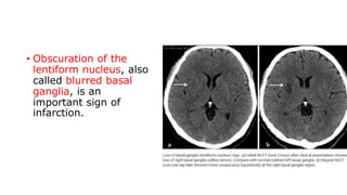 • Obscuration of the
lentiform nucleus, also
called blurred basal
ganglia, is an
important sign of
infarction.
 