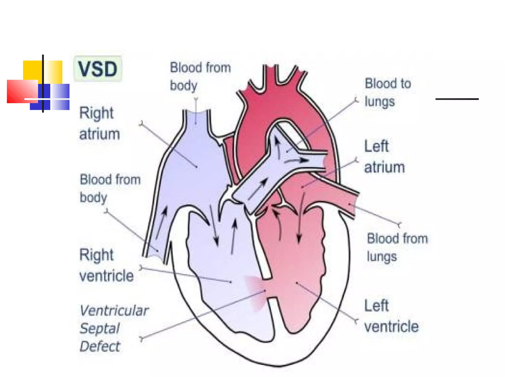 Vsd Management Ischemic ventricular septal_defects_dr.asma