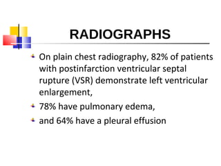 RADIOGRAPHS
On plain chest radiography, 82% of patients
with postinfarction ventricular septal
rupture (VSR) demonstrate left ventricular
enlargement,
78% have pulmonary edema,
and 64% have a pleural effusion
 