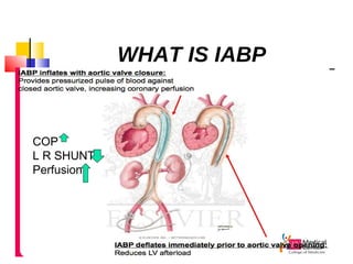 WHAT IS IABP
COP
L R SHUNT
Perfusion
 