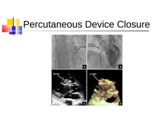 Percutaneous Device Closure
 