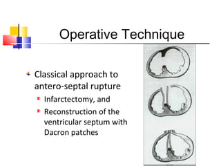 Operative Technique
Classical approach to
antero-septal rupture
Infarctectomy, and
Reconstruction of the
ventricular septum with
Dacron patches
 