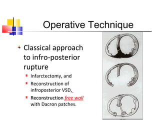 Operative Technique
Classical approach
to infro-posterior
rupture
Infarctectomy, and
Reconstruction of
infroposterior VSD,
ReconstructionReconstruction free wall
with Dacron patches.
 