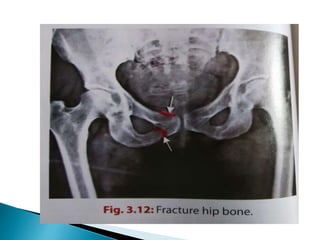 Ischium &amp; pubic 2