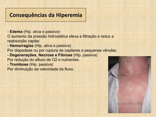 Consequências da Hiperemia
- Edema (Hip. ativa e passiva)
O aumento da pressão hidrostática eleva a filtração e reduz a
reabsorção capilar.
- Hemorragias (Hip. ativa e passiva)
Por diapedese ou por ruptura de capilares e pequenas vênulas.
- Degenerações, Necrose e Fibrose (Hip. passiva)
Por redução do afluxo de O2 e nutrientes.
- Trombose (Hip. passiva)
Por diminuição da velocidade do fluxo.
 