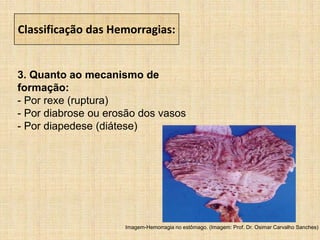 Classificação das Hemorragias:
3. Quanto ao mecanismo de
formação:
- Por rexe (ruptura)
- Por diabrose ou erosão dos vasos
- Por diapedese (diátese)
Imagem-Hemorragia no estômago. (Imagem: Prof. Dr. Osimar Carvalho Sanches)
 